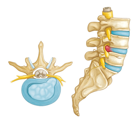 dolor de espalda por hernia intervertebral