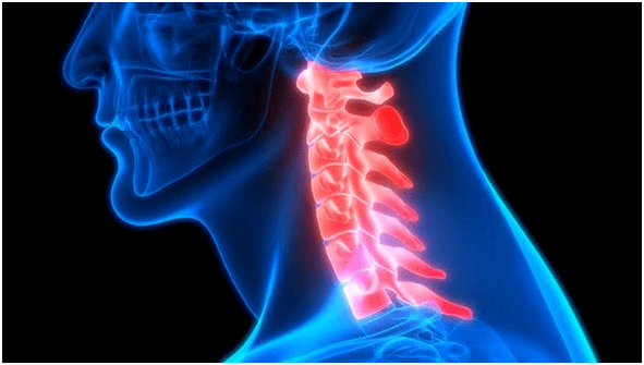 el dolor de cuello conduce a dolor de espalda