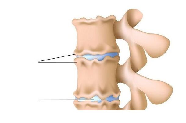 lesión de la médula espinal