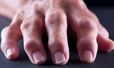 ¿Cuál es la diferencia entre la artritis de la osteoartritis
