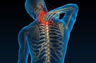 La osteocondosis cervical conduce al dolor de cuello