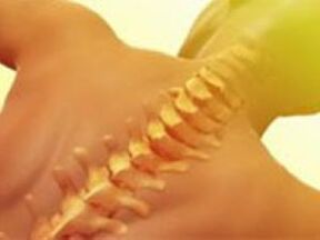 Osteocondrosis - Enfermedad de la columna vertebral