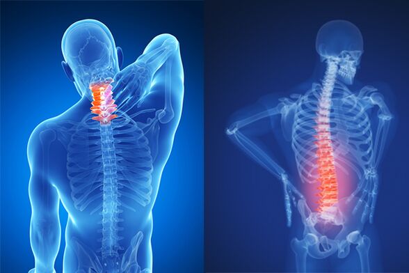Osteocondrosis de la columna cervical y lumbar.