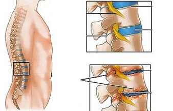Las causas de la osteocondosis de la lumbar
