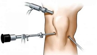 artroscopia para la osteoartritis de la articulación de la rodilla