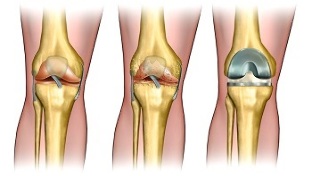 endoprótesis para la osteoartritis de la articulación de la rodilla